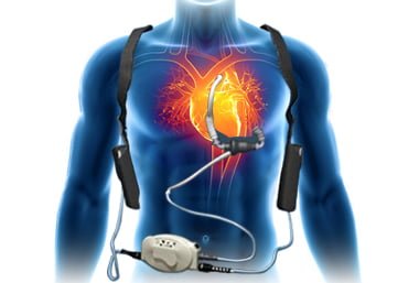 Corwave lvad 01